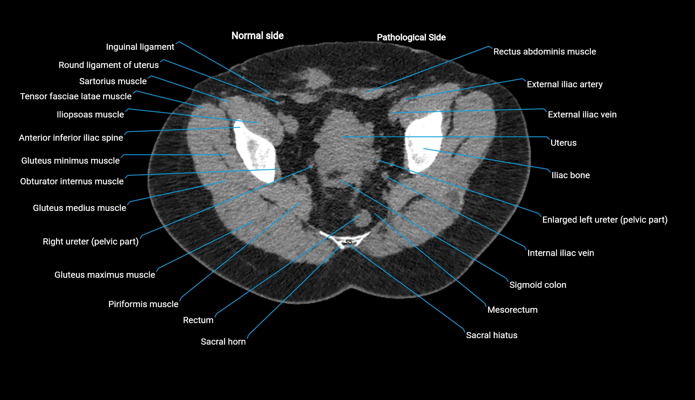 CT KUB axial cross sectional anatomy  radiology image -img-00201-00146.webp